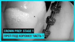 Crown prep Stage 1 Преп под коронку Часть 1 [upl. by Pisarik295]