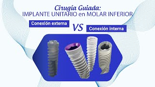 Cirugía Guiada IMPLANTE UNITARIO en MOLAR INFERIOR Conexión externa Vs Conexión interna [upl. by Ricoriki605]