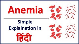 Anemia amp its types simple explaination in Hindi  Bhushan Science [upl. by Demmahum]