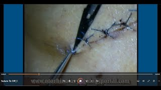 Suture To Off Removal of Sutures [upl. by Anitra]