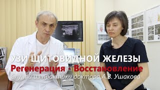 Лечение щитовидной железы заболевания щитовидной железы лечение  как вылечить щитовидную железу [upl. by Aural688]