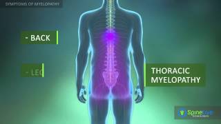 Myelopathy Symptoms [upl. by Jamel]