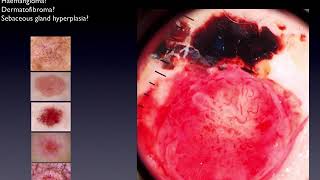 Red and Pink Lesions  Part 3  Dr Cliff Rosendahl [upl. by Cartwell]