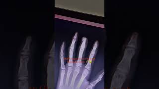 Finger fracture by bomb 💣💣 youtubevideo [upl. by Adlecirg572]