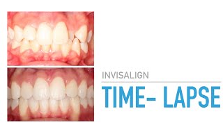 Invisalign TimeLapse TheOrthodonticCentre [upl. by Nytsrik891]