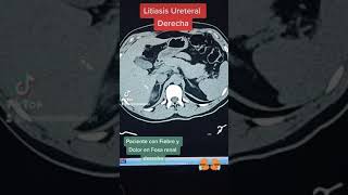 Litiasis ureteral derecha [upl. by Claudina434]