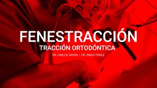 Fenestración de canino para tracción ortodóntica  Dr Carlos Gavira  Dr Pablo Fraile [upl. by Ahsaeyt]