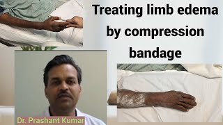 Treating limb edema by compression bandage [upl. by Kila]