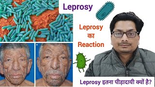 Lepromatous Leprosy  Leprosy का Reaction  Leprosy इतना पीड़ादायी क्यों है Hansens Disease कुष्ट [upl. by Madeline]