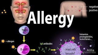 Allergy  Mechanism Symptoms Risk factors Diagnosis Treatment and Prevention Animation [upl. by Haldi]