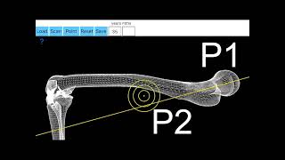 Anteversion Femoral measure with FAA App from itunes [upl. by Aggie]