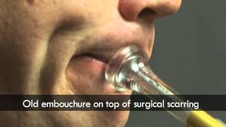 Trumpet embouchure before and after surgery [upl. by Damiano]