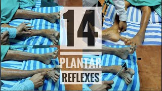 14 Abnormal plantar reflexes Babinski equivalents [upl. by Nagad229]