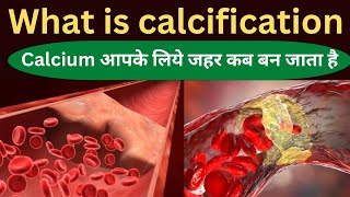 calcificationcalcification kya hota haicalcification in hindi calcification in brain [upl. by Clemence]