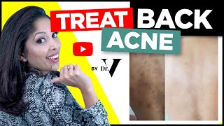 How To Treat Back Acne FAST  Doctors Tips  Skin of Colour AsianBlack  Treat Backne  DR V [upl. by Amoeji]