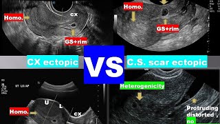 lecture 9 ultrasound of bleeding in early pregnancy 2 [upl. by Eedrahs]