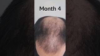 FUE Hair Transplant Timeline  Day 1 to Day 365  Before amp After  6100 Grafts hairtransplant [upl. by Hau]