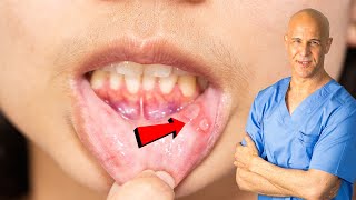 How I Quickly Healed My Canker Sore  Dr Mandell [upl. by Notgnimer265]