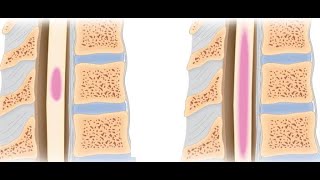 intramedullary lesion [upl. by Alegna]