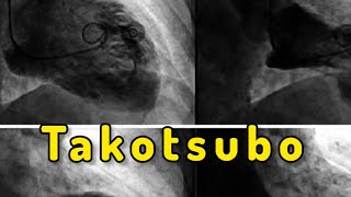 Takotsubo Cardiomyopathy “Broken Heart Syndrome” [upl. by Lleder]