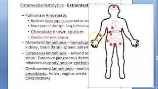 Parasitology 026 e Extraintestinal Amoebiasis entamoeba histolytica hepatic liver abscess anchovy [upl. by Alan733]