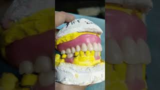 Denture Ready for Flasking 😁😁😁fulldenture rpddentalprocedure dentalartbyhaider [upl. by Beverley]