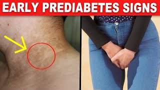 9 Early PREDIABETES Warning Signs Youre Unaware Of [upl. by Arakihc]