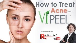 Vi PEEL ACNE  Chemical Peel for Acne Scaring [upl. by Earized379]