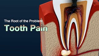 Causes of Severe Toothache and How to Relieve the Pain [upl. by Quartis]