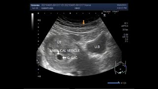 Early pregnancy 10 days past the due date of menses [upl. by Einomrah829]