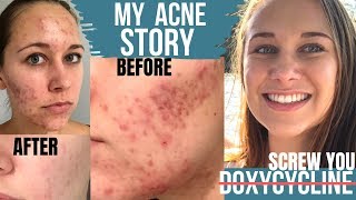 Acne Antibiotics DOXYCYCLINE MAKES ACNE WORSE  My Acne Story BEFORE amp AFTER with PICTURE TIMELINE [upl. by Liew968]