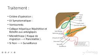 GASTRO  Lithiase Vésiculaire [upl. by Ahsetel]