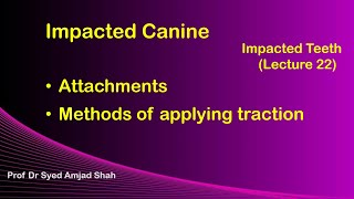 Attachments amp methods of applying traction for Impacted Canine  Syed Amjad Shah [upl. by Carmita]