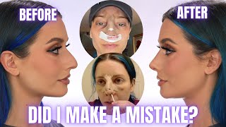 CLOSED RHINOPLASTY NOSE JOB VLOG  SURGERY DAY DAY BY DAY RECOVERY amp CAST REMOVAL REVEAL [upl. by Euqilegna]