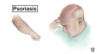 Mayo Clinic Minute  Psoriasis of the scalp [upl. by Arhna415]