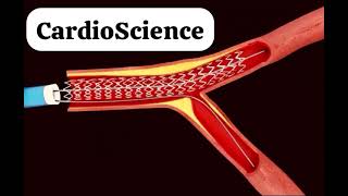 Angioplastia coronaria en lesión bifurcadaTAP [upl. by Rosaline]
