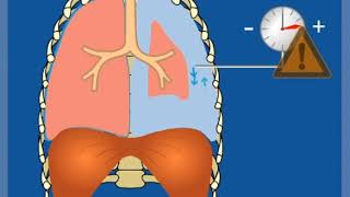 Loch mit Ventilfunktion Ventilpneumothorax – Grundlagen  Thoraxdrainage für Einsteiger [upl. by Haimes]