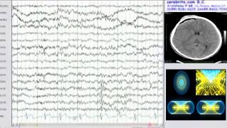 encefalograma [upl. by Christen]