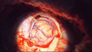 LOW GRADE GLIOMA [upl. by Bruns]