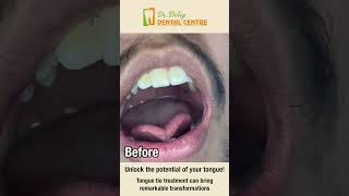 Tongue tie removal with Laser  Dr Dilip Dental Centre [upl. by Cranford]