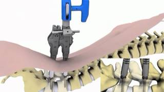 ChoiceSpine Silverbolt perkutane Instrumentierung [upl. by Blakeley]