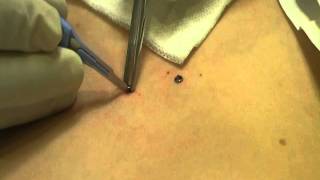 Microdermal Dermal Anchor Removal at MediZen Cosmetic Clinic Birmingham UK [upl. by Danna]