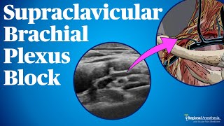 Supraclavicular Brachial Plexus Block [upl. by Lucita515]