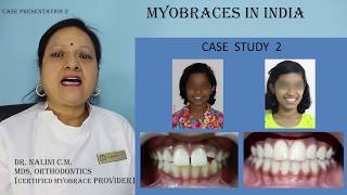 Myobrace case presentation 2 [upl. by Aivato]