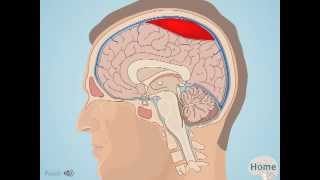 Subdural Hematoma [upl. by Nhguavahs]