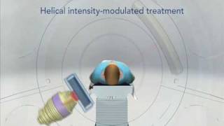 TomoTherapy  Revolutionary Radiation Therapy [upl. by Jasmine]