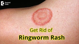 7 GREAT Tips for Prevention amp Treatment of RINGWORM RASH Dr Amrita Hongal Gejje  Doctors Circle [upl. by Goldberg]