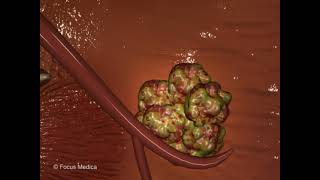 Renal cell carcinoma RCC  Oncology [upl. by Akenihs]