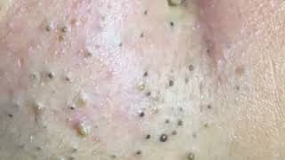 how to remove blackheads from forehead at home  blackheads white  how to remove small pimples [upl. by Delfine545]