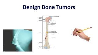 Benign Bone Tumors Made Simple [upl. by Akeenahs]